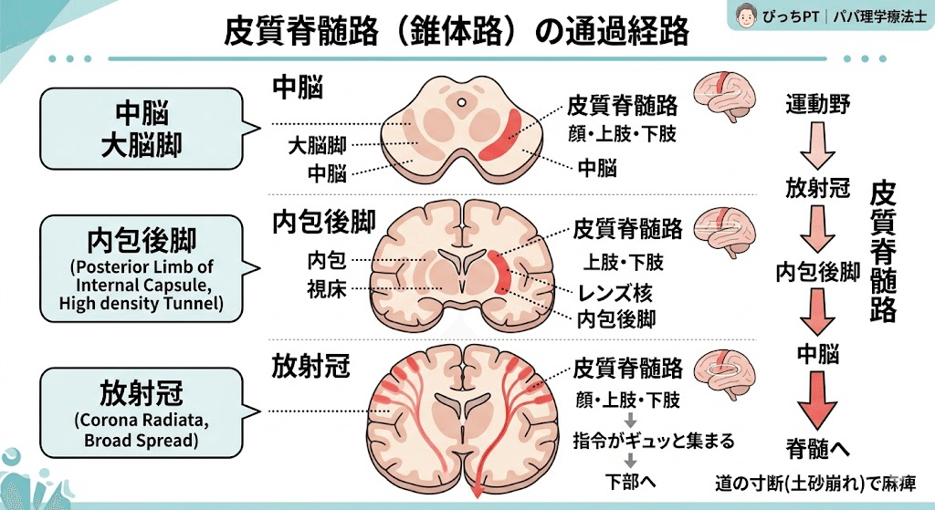 ②【新人:脳卒中】脳画像で麻痺だけは確認必須!見切りで介入しないために 本文図1
